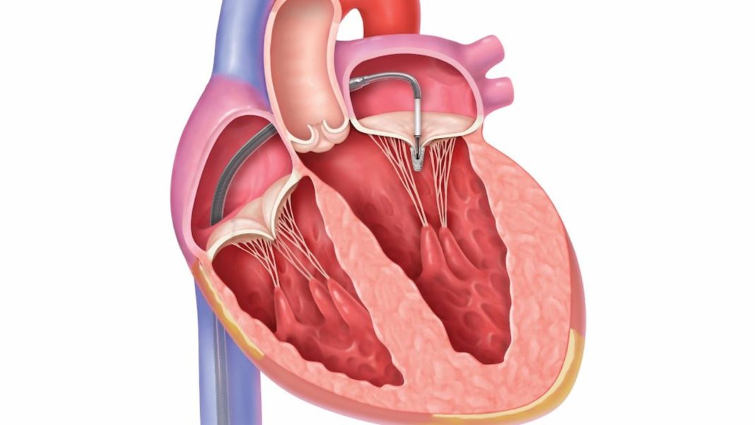 How Long Do You Live After Mitral Valve Repair